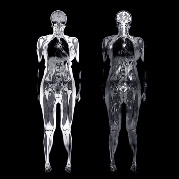 WBMRI SCAN Result (600 x 600 px) Whole Body MRI scan results