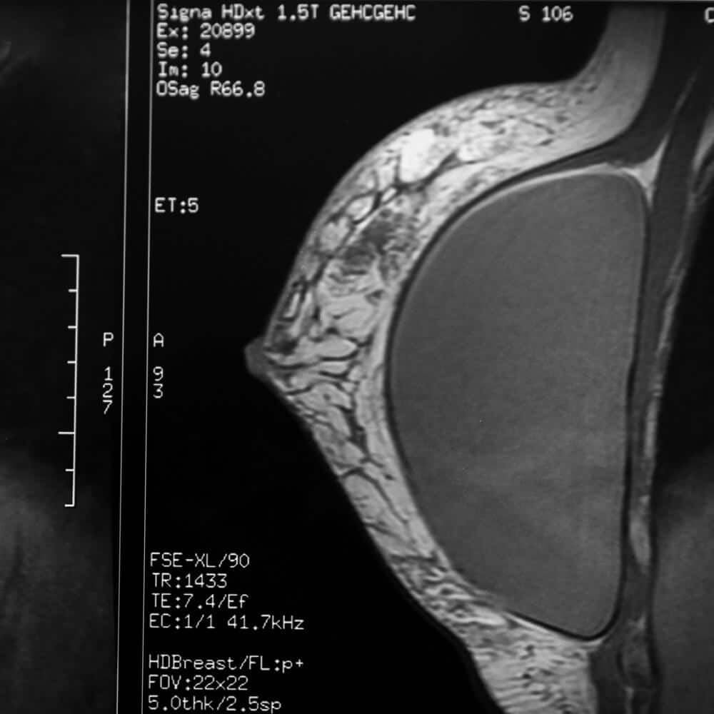 wbmribreastimpantmri (1)