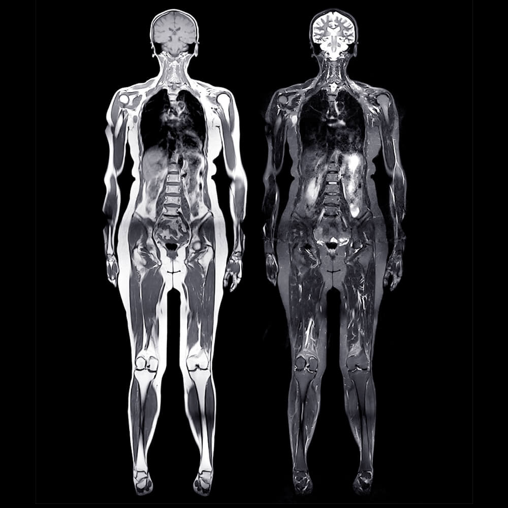 wholebodymrisigscan (1)